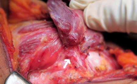 Thyroid Surgeon in Hyderabad
